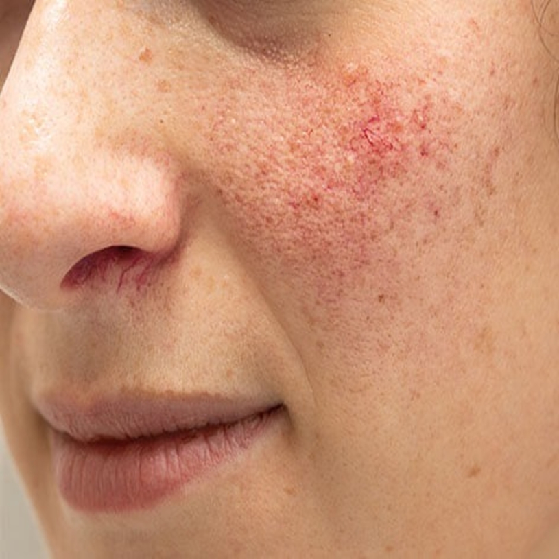 av_header_rosacea_allgemein_472x389px.jpeg